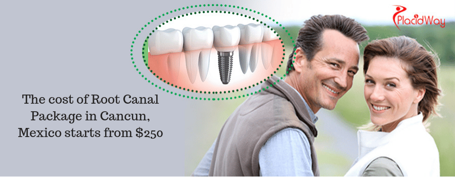 The cost of Root Canal Package in Cancun, Mexico starts from $250